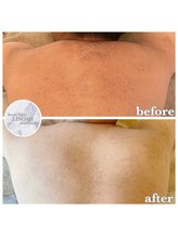 リノア 心斎橋店(LINOAH)/背中全体の脱毛　b → a