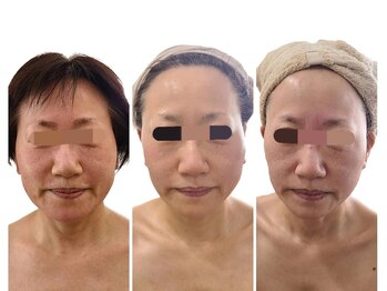 ウォーマル(warmaL)/小顔矯正/1回より2回3回目！