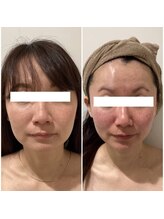 ラバ 名古屋栄店(LAVA)/小顔コルギ【エラ張り】