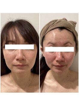 ラバ 名古屋栄店(LAVA)/小顔コルギ【エラ張り】