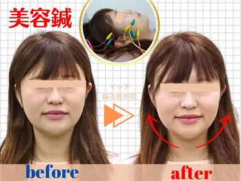 マッチ鍼灸整骨院/美容鍼＆小顔矯正でリフトアップ