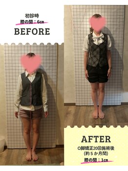 守谷やまゆり鍼灸整骨院/О脚矯正！！