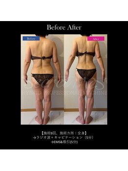 フェレザ 新潟(Felleza)/新潟-痩身エステ-BODYエステ