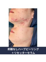 エルア 尼崎(Elua)/しつこい大人ニキビも