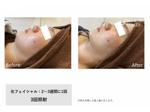 モイ(Moi’e)/ニキビ・シミ・たるみ