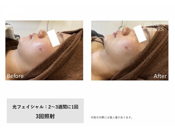 モイ(Moi’e)/ニキビ・シミ・たるみ