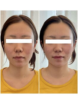 ニコワ(Nicowa)/Nicowaのコルギ★BeforeAfter