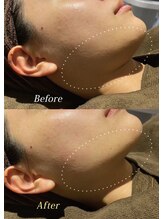 アネル 新都心店(anel)/小顔　リフトアップ　《那覇》