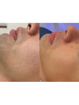 メンズフェイシャル