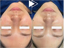 リシェス(Richesse)/艶肌ピーリング★初回¥9990