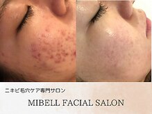 ミベル フェイシャルサロン(MIBELL FACIAL SALON)