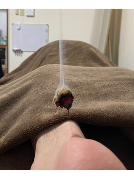 ジェネ鍼灸院/踵・アキレス腱の痛みは灸頭鍼！