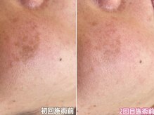 ベルエクラ(Bel Eclat)/シミ改善　那覇おもろまち駅近く