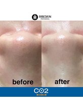 ウィズリリナ 新横浜(with Lilina.)/1回/カーボキシー/炭酸パック