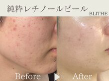 ブライス(BLITHE)/Before After 
