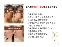 ラフォクシー(La.Foxy)/小顔フェイシャル