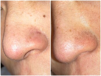 ABBメディカルサロン 平針店/毛穴の黒ずみ