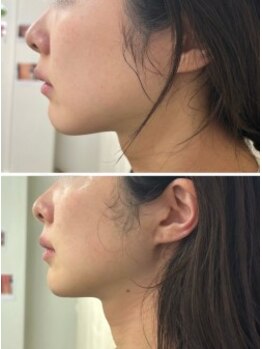 シャトン ボーテ(chaton beaute)/レモンボトルビフォーアフター☆