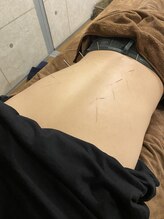 ハリトマト 梅田中崎/施術（腰痛・便秘改善施術）