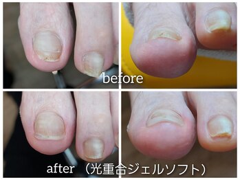 【ジェル人工爪】