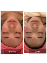 サロンドデュイ/1回施術/20代/乾燥肌/保湿ケア