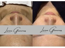 ラリマ グラマラス(Larima Glamorous)/通うほどに肌質改善