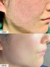 エモーショナル 姫路(Emotional)&nbsp;ララピール ピーリング