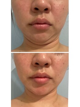 ルナグランデ(Luna grande.)/脂肪分解5ml 1回で二重顎撃退