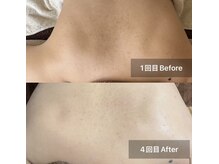 ハオン(HAON)/ブライダル用背中ケアも可能です