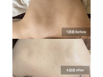 ハオン(HAON)/ブライダル用背中ケアも可能です