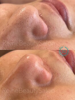 レーヌ(Reine)/毛穴エクストラクションお顔脱毛