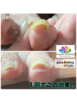 サロンドットプディング(Salon.Pudding)/深刻な巻き爪のお客様写真