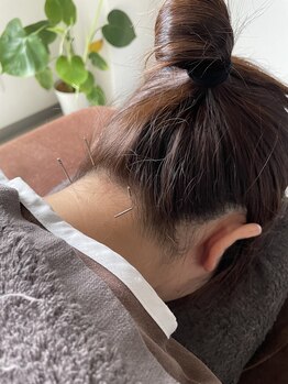アイリス鍼灸 マッサージヴィラ(Iris鍼灸 マッサージvilla)/首の鍼