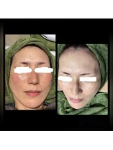 ココスタイルビューティー(COCOSTYLE beauty)/シミケア