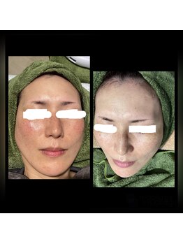 ココスタイルビューティー(COCOSTYLE beauty)/シミケア