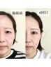 《フェイシャル》体験/リバウンドしない小顔へ！  16500円→8800円