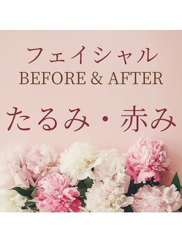 ゼロ 水戸店(ZERO)/たるみ・赤み★before&after↓