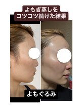 よもぐるみ 桃山台店/ビフォーアフター[よもぎ蒸し]