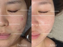 ライフサロン 天神(Life Salon)の雰囲気（【美容鍼】小顔/リフトアップ/フェイスライン◎Before/After）