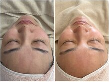 マヴィ 香里園店(MavY.)/ノンニードル水光注入