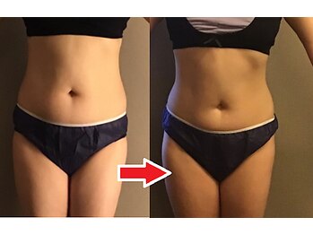 トータルボディサロン グリーン 日本橋駅前店(Green)/痩身成功例【６か月コース】