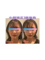 カドモリ 四ツ橋(KADOMORI) 左右差のバランスと中顔面のアプローチ【小顔矯正/美容鍼/整体】