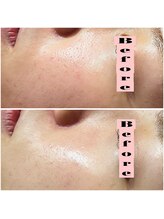 リンク(LiNK)/ハーブピーリング