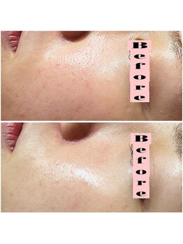 リンク(LiNK)/ハーブピーリング