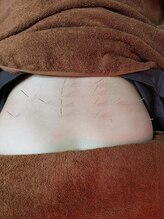 乃々鍼灸整体院 表参道/腰痛施術