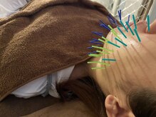 ハリトマト 梅田中崎/施術（くすみ・ほうれい線）