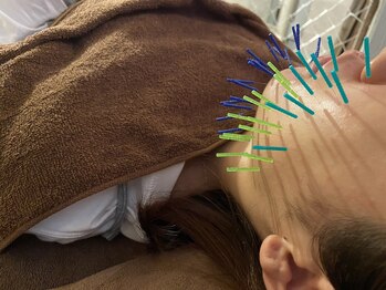 ハリトマト 梅田中崎/施術(くすみ・ほうれい線)