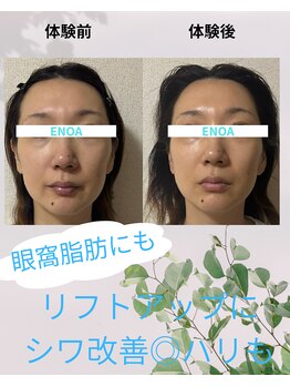 エノア(ENOA)/レッドショット眼窩脂肪にも