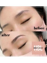 エヌプラス(N+)/ハリウッドブロウリフト(HBL)