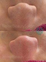 レーヌ(Reine)/毛穴エクストラクションお顔脱毛